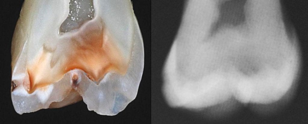 mo-caries-xray-and-histo-xsection