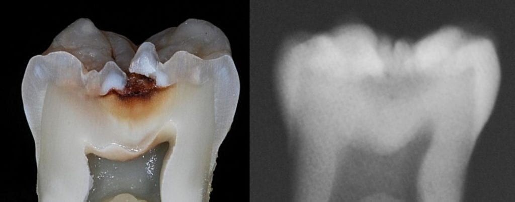 o-caries-xray-and-histo-xsection