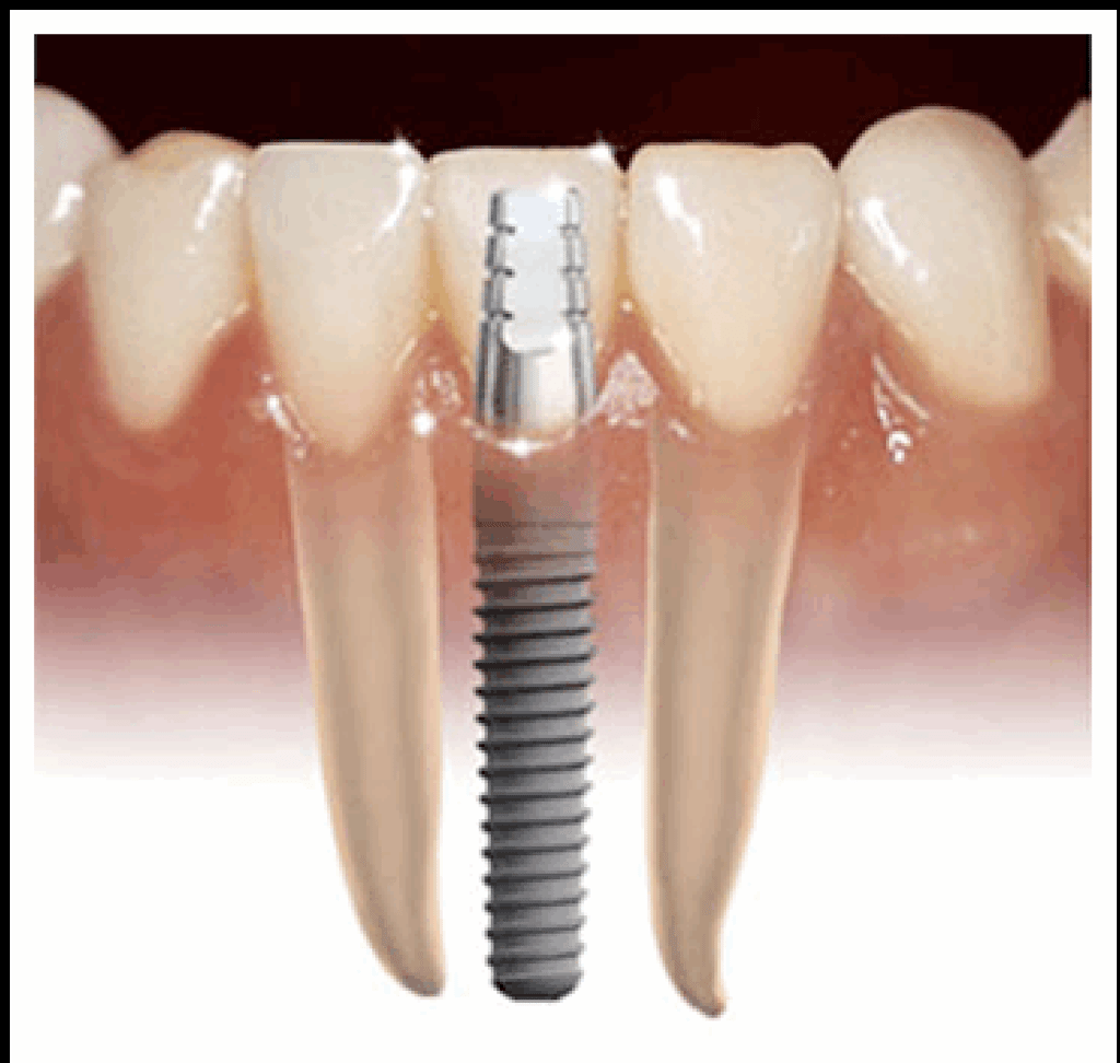 single-implant